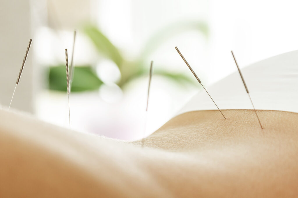 acupuncture and Traditional Chinese Medicine