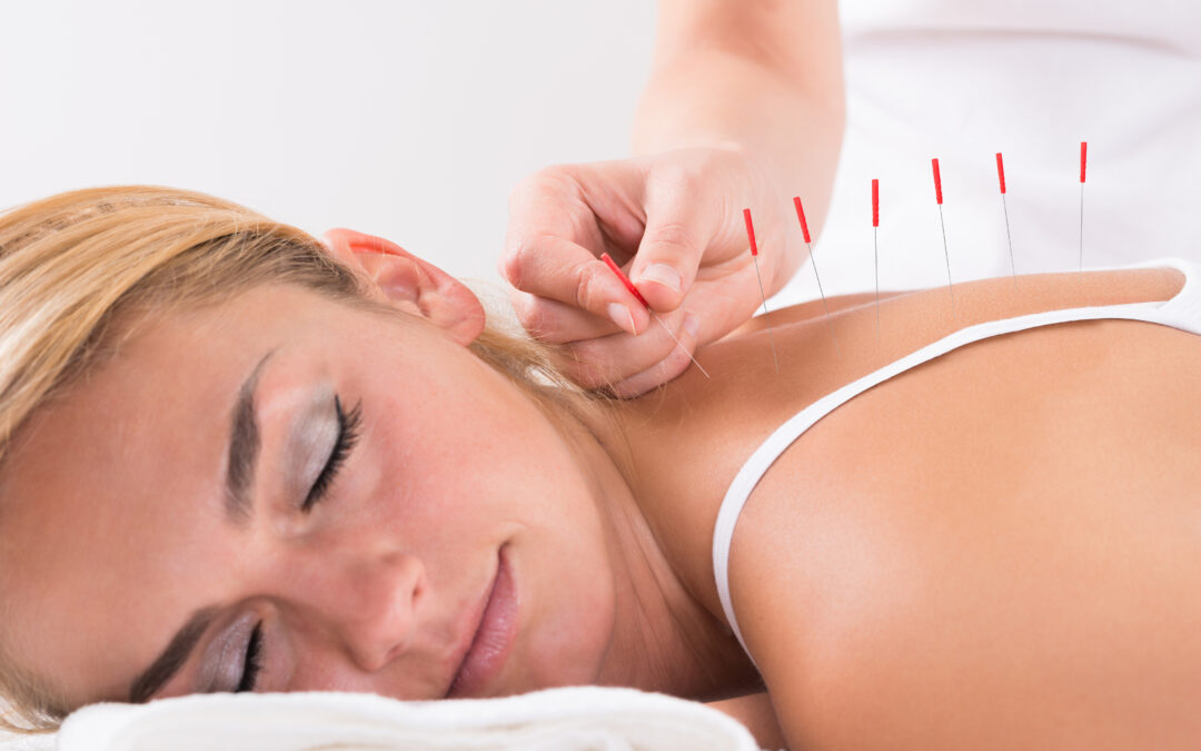 Does Acupuncture Hurt? 3 Reasons You Needn’t Fear the Needle