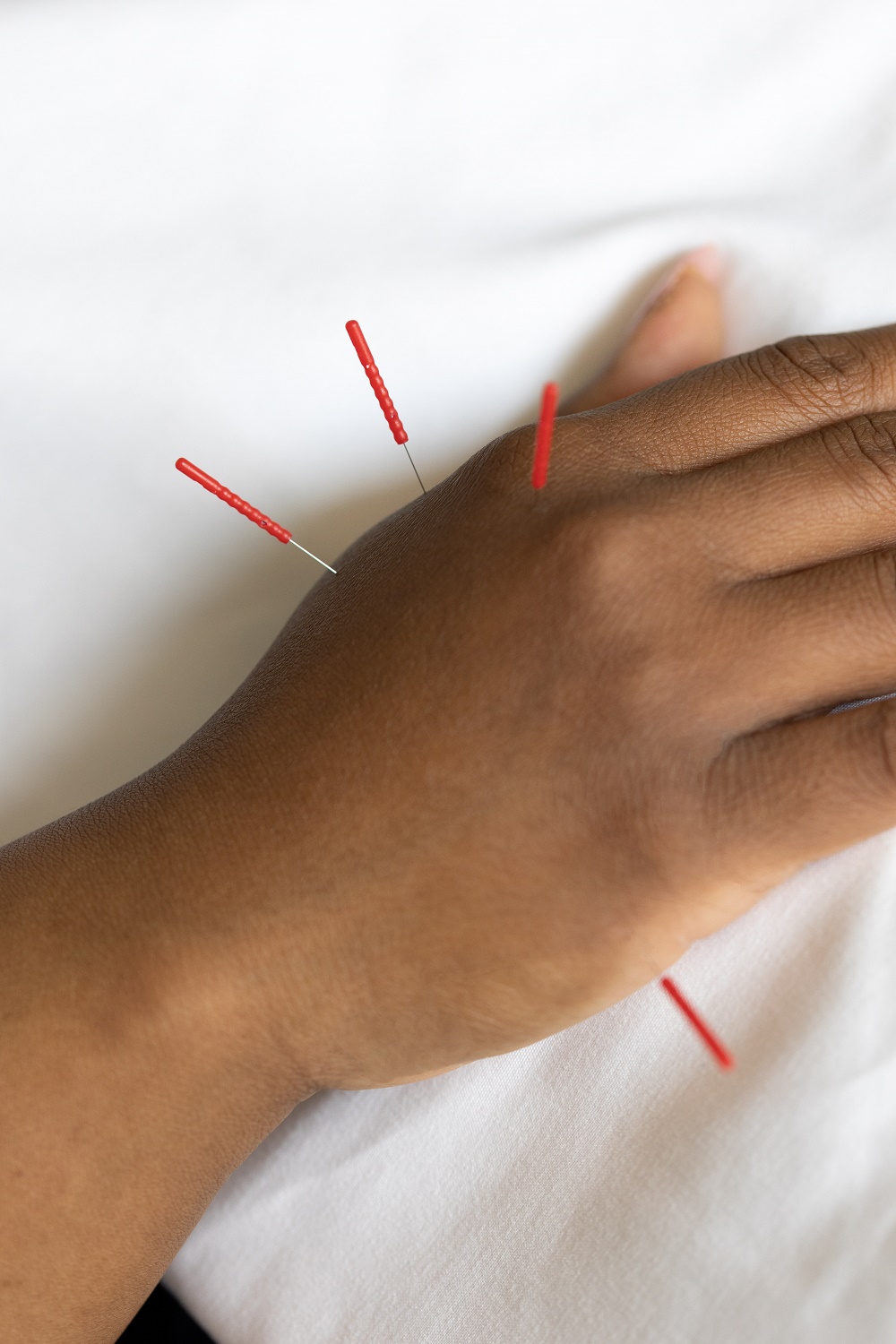Acupuncture needles are inserted in someone's right hand in an example of local and distal acupuncture.