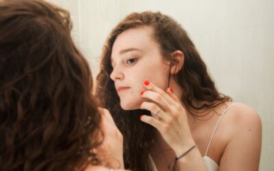Adolescents and Acne: 5 Reasons to Consider Acupuncture Treatment for Teens