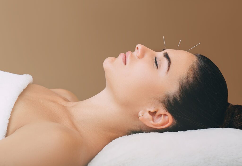 A woman lying down with acupuncture needles in her forehead for treatment of headaches and migraines for what can acupuncture treat blog.