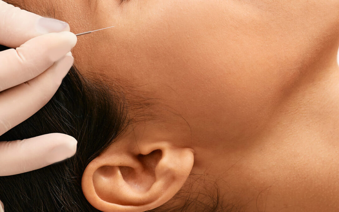 Facial Rejuvenation, Microneedling, and The Cosmetics of Acupuncture