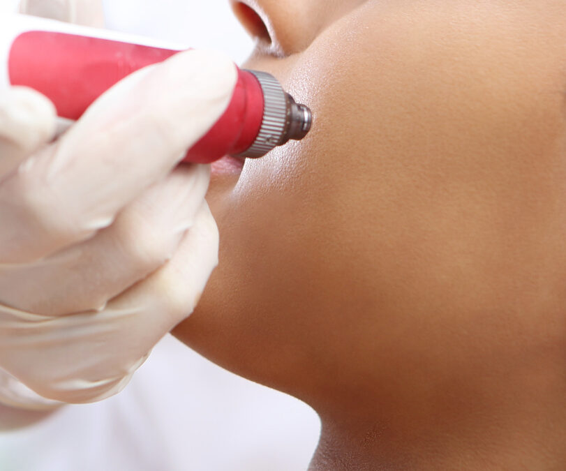 Nano-Needling vs Microneedling – What is the Difference?