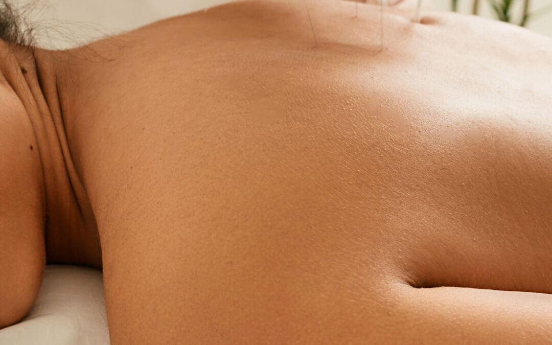 How Long do the Effects of Acupuncture Last?