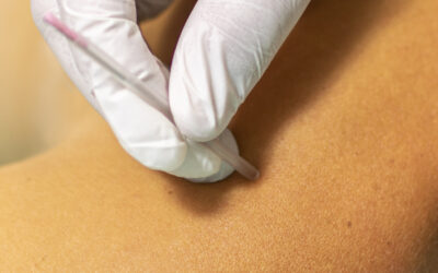 What is Dry Needling? Discovering the Benefits for Patients