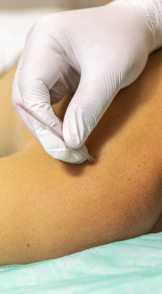 what is dry needling