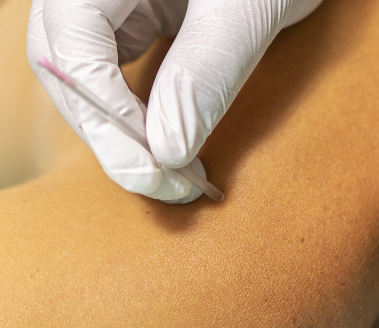 What is Dry Needling? Discovering the Benefits for Patients