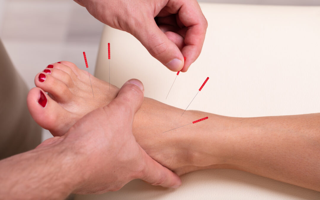 Can Acupuncture Help with Foot Pain?