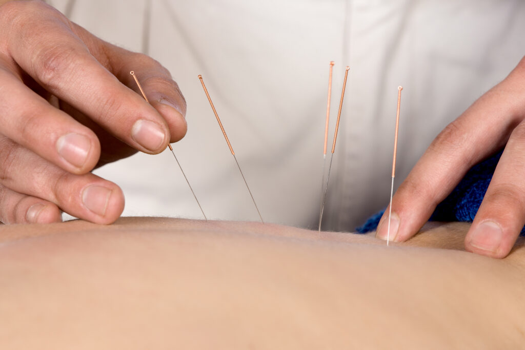 can acupuncture help with ibs