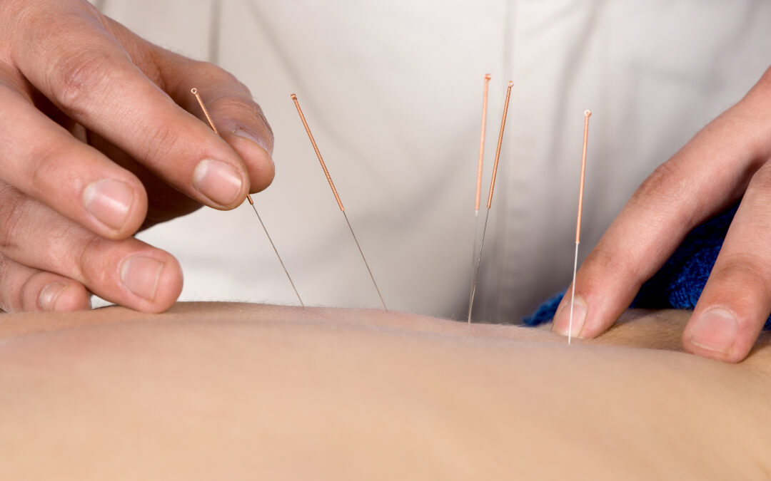 Can Acupuncture Help with IBS and Crohn’s Disease? Traditional Chinese Medicine’s Impact on Gut Health