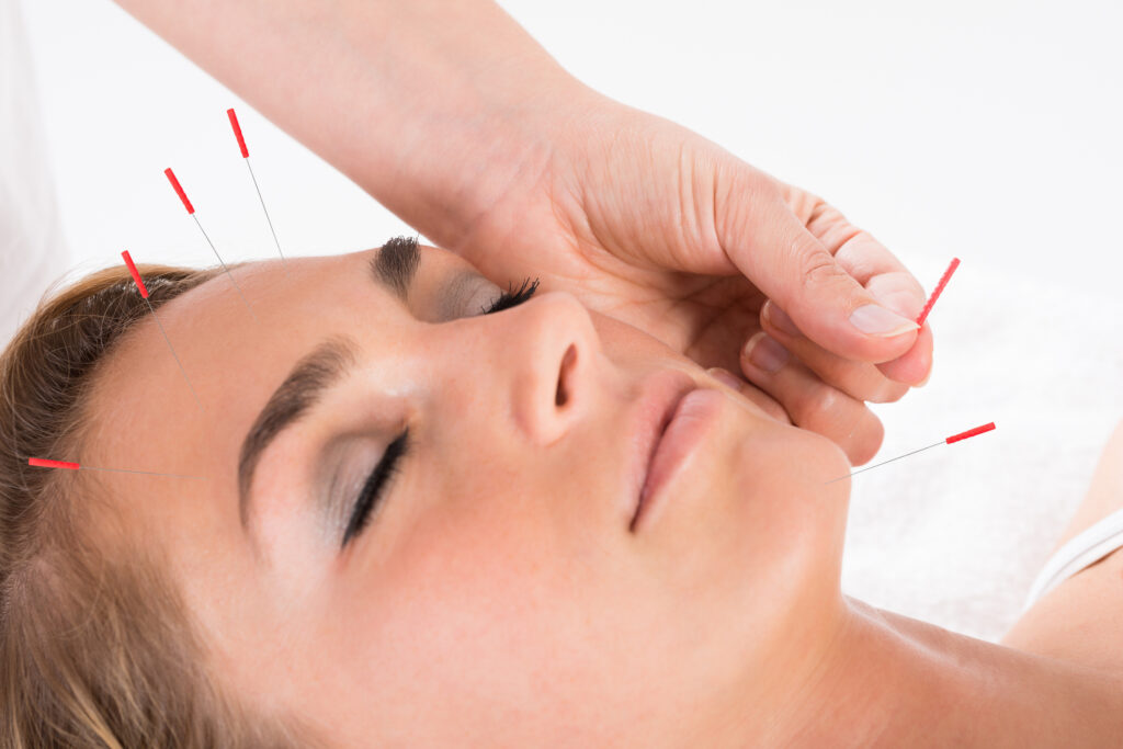 can acupuncture improve your focus