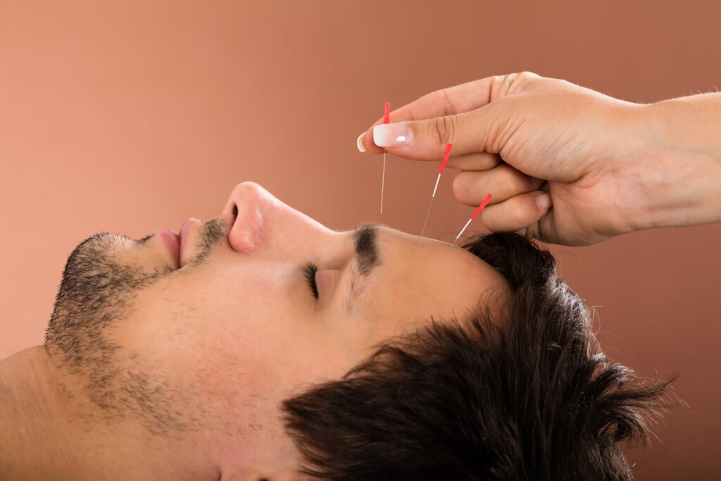 how often should you get acupuncture