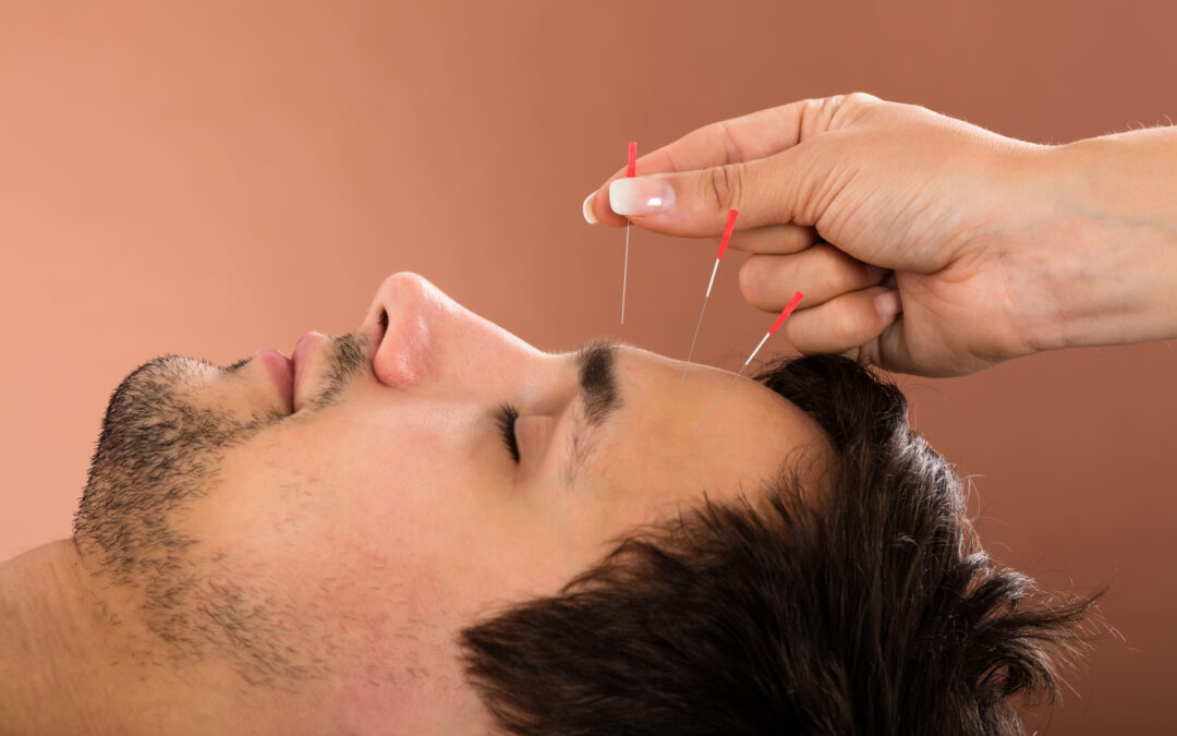 How Often Should You Get Acupuncture?