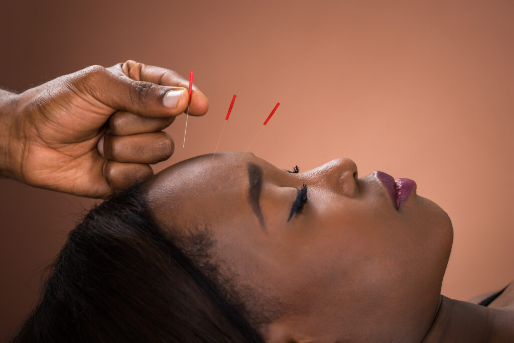 should I use acupuncture for anxiety