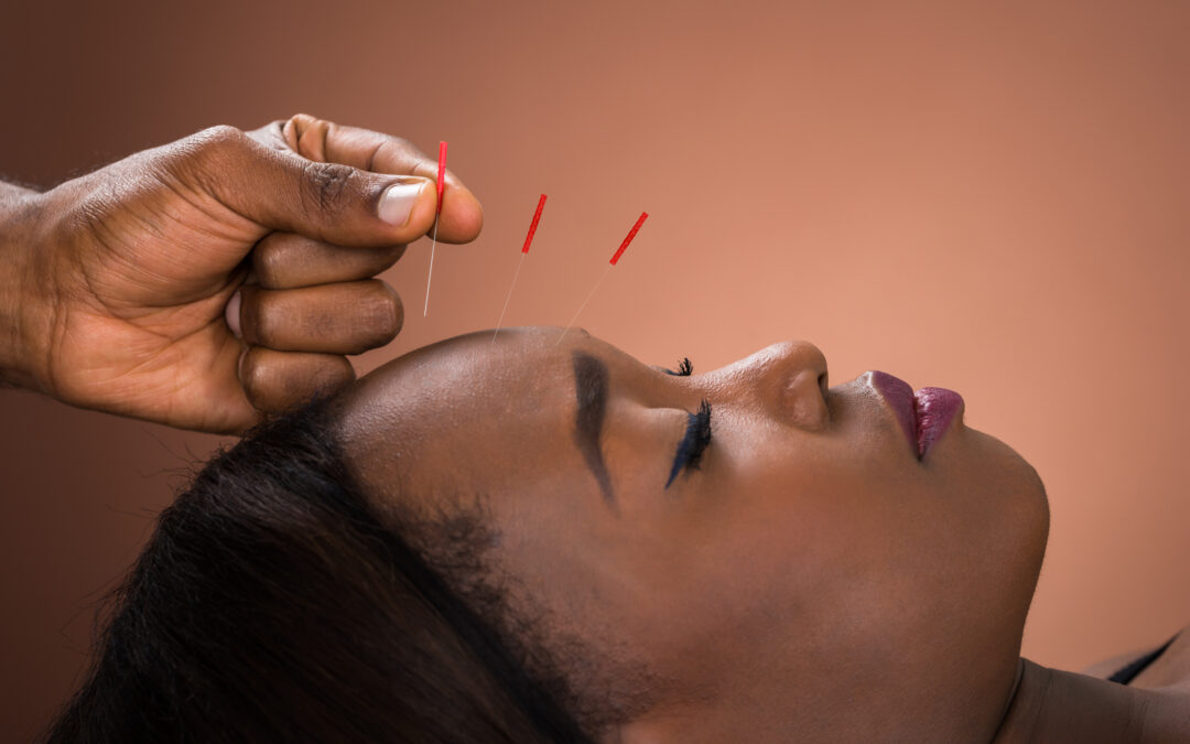 Should I Get Acupuncture for Anxiety?
