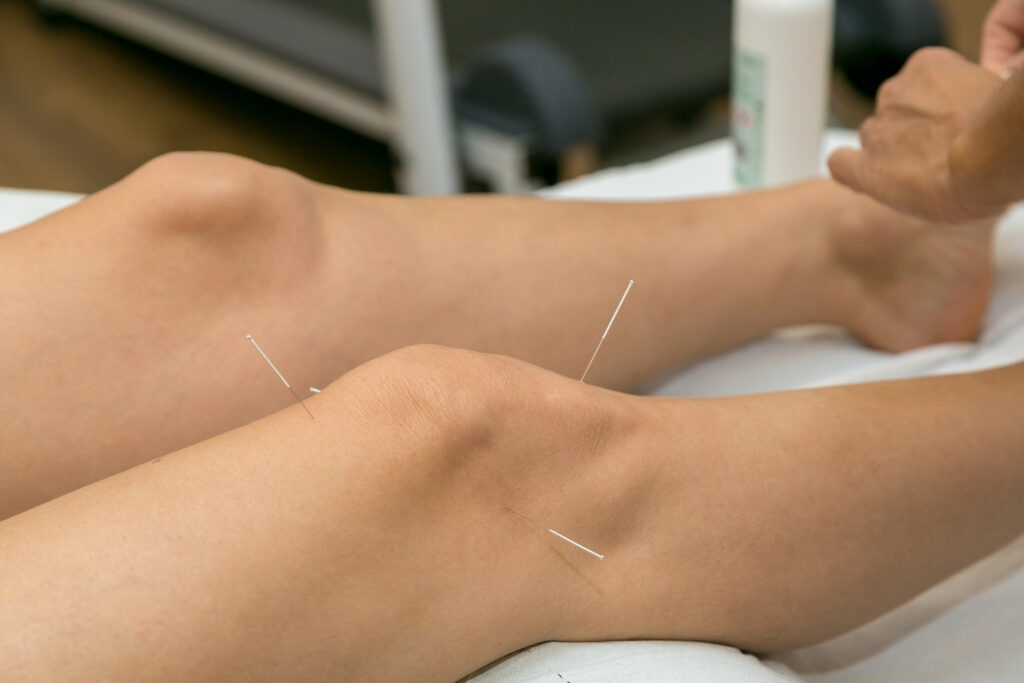 can-acupuncture-support-bone-health