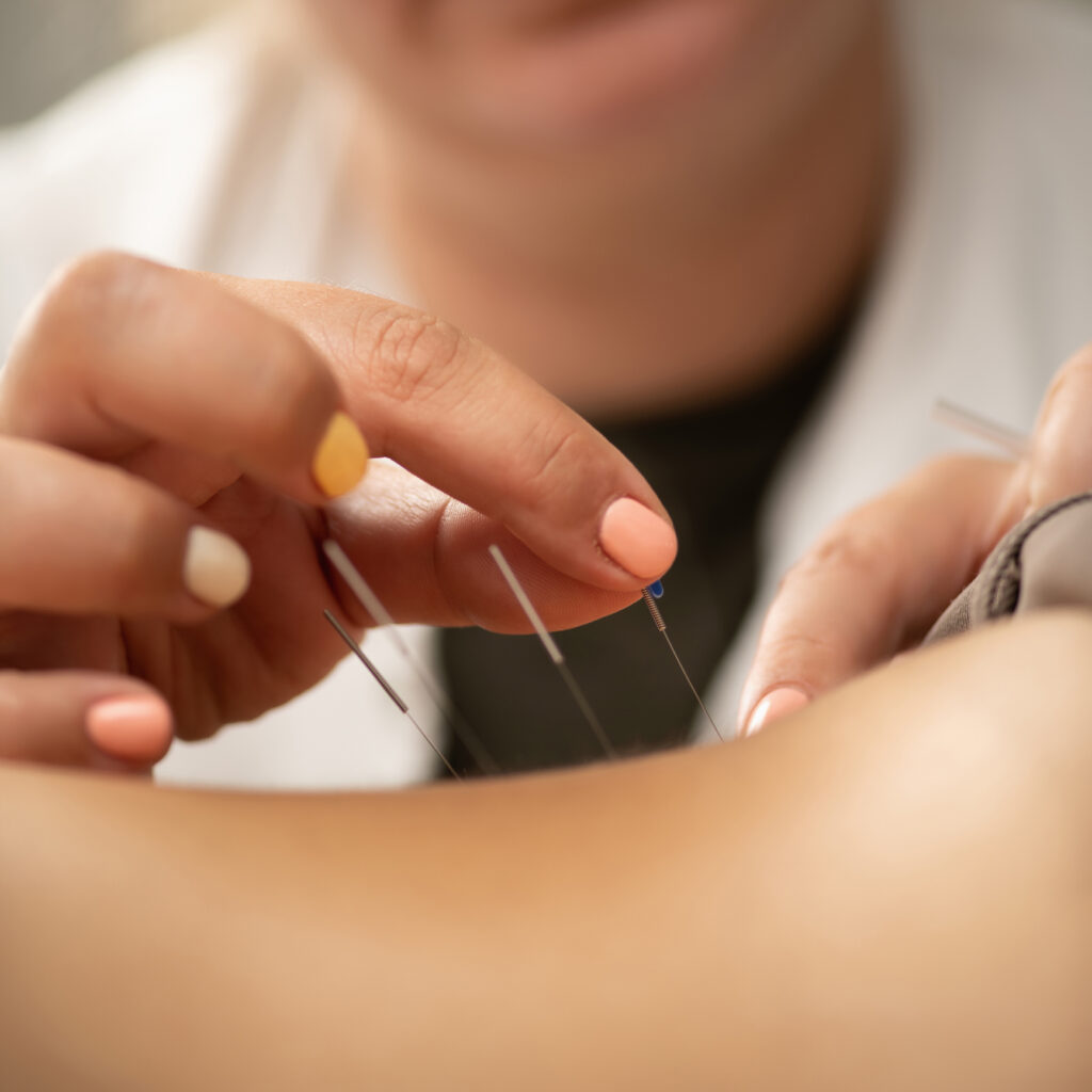 A practitioner uses dry needling on a female patient to relieve lower back pain for dry-needling-vs-acupuncture blog.