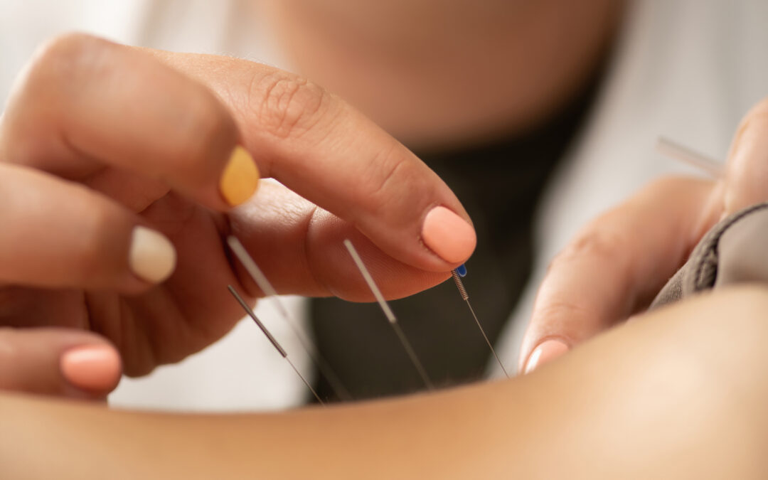 Dry Needling vs. Acupuncture: What’s the Difference?