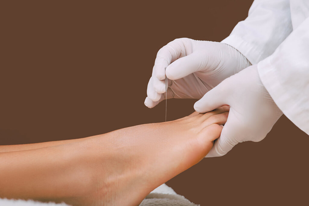 Acupuncture being performed on a foot for traditional-chinese-medicine-post-surgical-recovery blog.